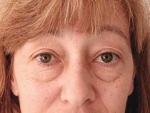 Eyelid surgery (Blepharoplasty)