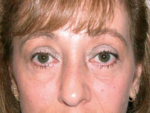 Eyelid surgery (Blepharoplasty)