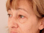 Eyelid surgery (Blepharoplasty)