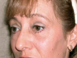 Eyelid surgery (Blepharoplasty)