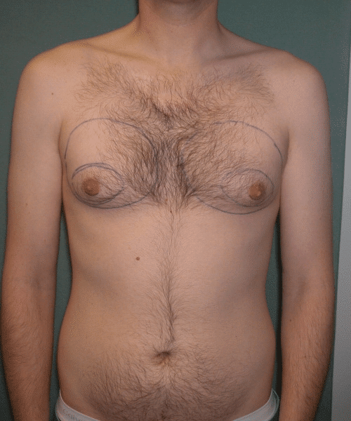 Puffy Nipples Before Photo Puffy Nipples