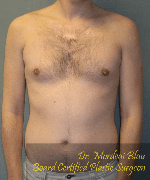 Puffy Nipples After Photo Puffy Nipples