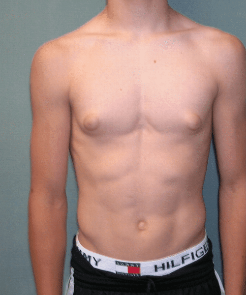 Puffy Nipples Before Photo Puffy Nipples