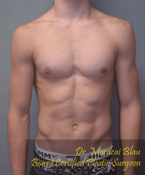 Puffy Nipples After Photo Puffy Nipples