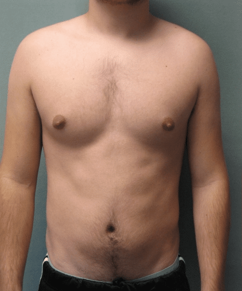 Puffy Nipples Before Photo Puffy Nipples