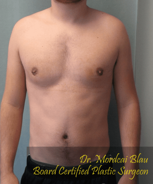 Puffy Nipples After Photo Puffy Nipples