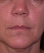 Lip Augmentation