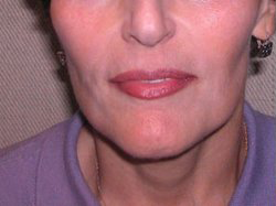 Lip Augmentation