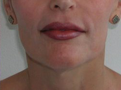 Lip Augmentation