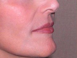 Lip Augmentation