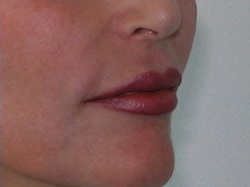 Lip Augmentation