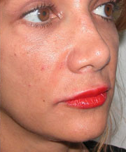 Lip Augmentation