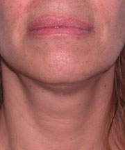 lip augmentation