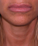 Lip Augmentation