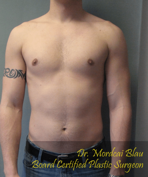 Puffy Nipples After Photo Puffy Nipples