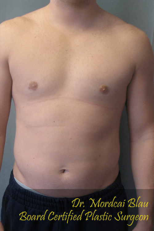 Puffy Nipples Before & After Photos Case # 40 - 1