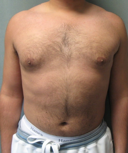 Puffy Nipples Before & After Photos Case # 41 - 1