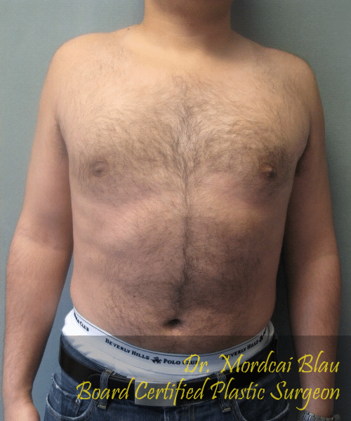 Puffy Nipples After Photo Puffy Nipples