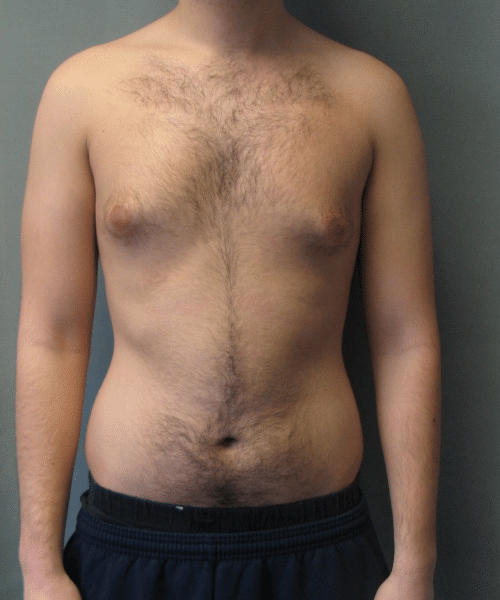 Puffy Nipples Before Photo Puffy Nipples