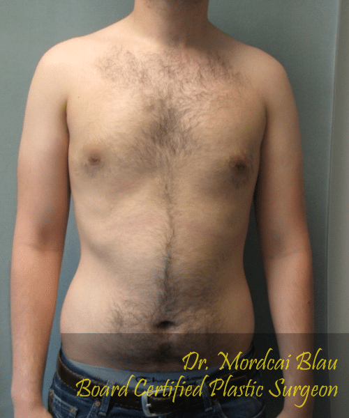Puffy Nipples After Photo Puffy Nipples
