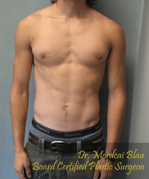 Puffy Nipples After Photo Puffy Nipples