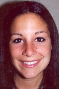 Nose Surgery (Rhinoplasty) After Photo Nose Surgery (Rhinoplasty)