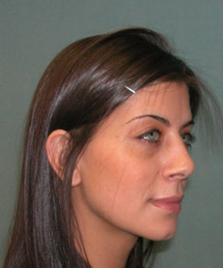 Nose Surgery (Rhinoplasty)