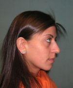 Nose Surgery (Rhinoplasty)