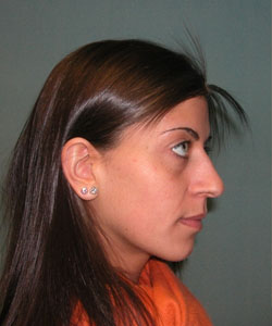 Nose Surgery (Rhinoplasty)