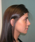 Nose Surgery (Rhinoplasty)