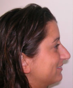 Nose Surgery (Rhinoplasty)