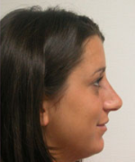 Nose Surgery (Rhinoplasty)