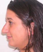 Nose Surgery (Rhinoplasty)