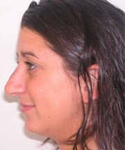 Nose Surgery (Rhinoplasty)