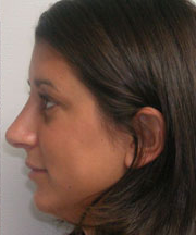 Nose Surgery (Rhinoplasty)