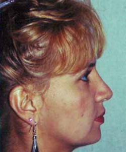 Nose Surgery (Rhinoplasty)