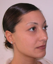 Nose Surgery (Rhinoplasty)