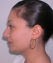 Nose Surgery (Rhinoplasty)