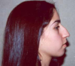 Nose Surgery (Rhinoplasty)