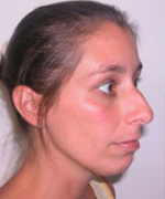 Nose Surgery (Rhinoplasty)