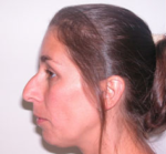 Nose Surgery (Rhinoplasty)