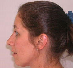 Nose Surgery (Rhinoplasty)