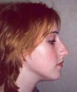 Nose Surgery (Rhinoplasty)