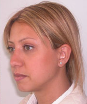 Nose Surgery (Rhinoplasty)