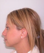 Nose Surgery (Rhinoplasty)