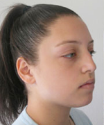 Nose Surgery (Rhinoplasty)