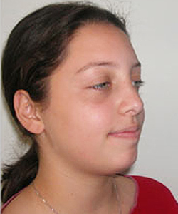 Nose Surgery (Rhinoplasty)