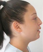 Nose Surgery (Rhinoplasty)