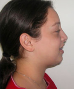 Nose Surgery (Rhinoplasty)