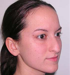 Nose Surgery (Rhinoplasty)